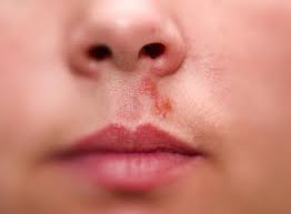 Herpes Pictures – Herpes Pictures and Cold Sores Pictures